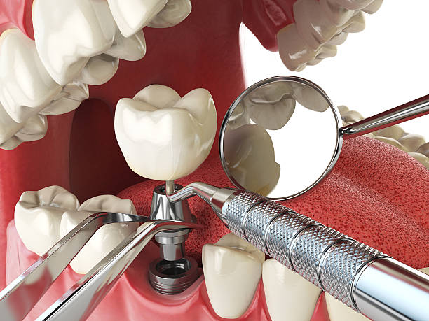 Best Emergency Root Canal Treatment in Maria Stein, OH
